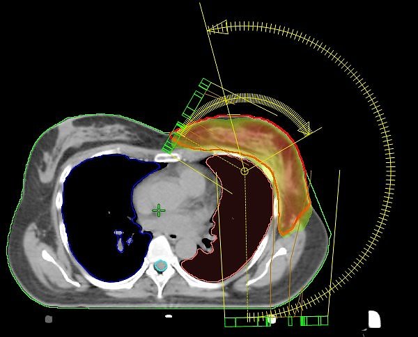 VMAT-Bewegungsbestrahlungstechnik (Foto: Südharz Klinikum) VMAT-Bewegungsbestrahlungstechnik (Foto: Südharz Klinikum)